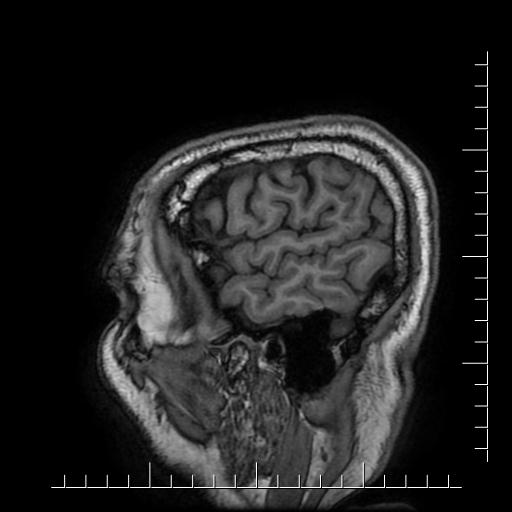 Aneurysm of posterior communicating artery (Radiopaedia 20188-20163 Sagittal T1 63).jpg