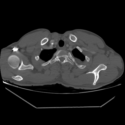 Aneurysmal bone cyst - rib (Radiopaedia 82167-96220 Axial bone window 49).jpg