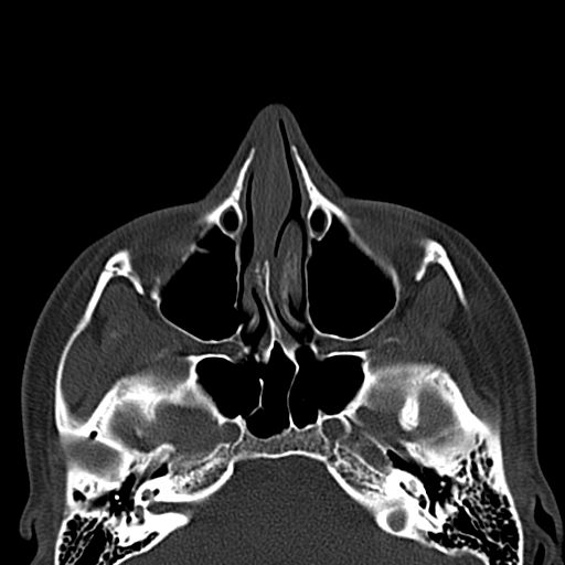 Aneurysmal bone cyst of the mandible (Radiopaedia 43280-46601 Axial bone window 82).jpg