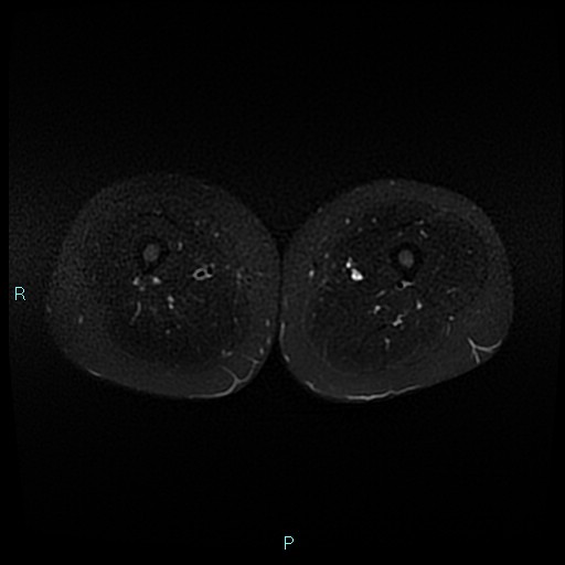 Angioleiomyoma (Radiopaedia 85442-101078 Axial STIR 53).jpg