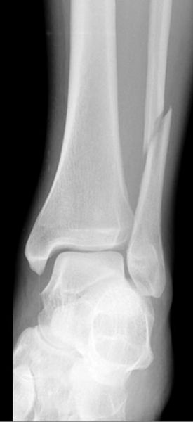 File:Ankle fracture - Weber C (Radiopaedia 12268-12568 Frontal 1).jpeg