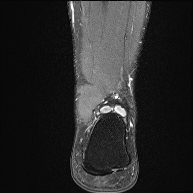Ankle syndesmotic injury (Radiopaedia 69066-78837 Coronal PD fat sat 14).jpg