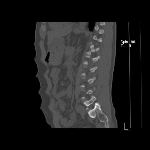 File:Ankylosing spondylitis (Radiopaedia 52728-58645 Sagittal bone window 3).jpg