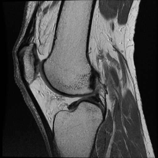 Anomalous insertion of the medial meniscus (Radiopaedia 77559-89721 Sagittal PD 23).jpg