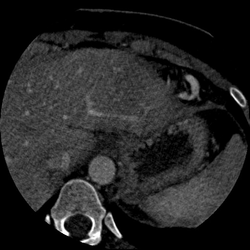 File:Anomalous left coronary artery from the pulmonary artery (ALCAPA) (Radiopaedia 40884-43586 A 89).jpg
