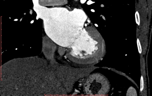 Anomalous left coronary artery from the pulmonary artery (ALCAPA) (Radiopaedia 70148-80181 B 180).jpg