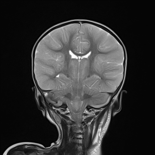 File:Anoxic brain injury (Radiopaedia 79165-92139 Coronal T2 17).jpg