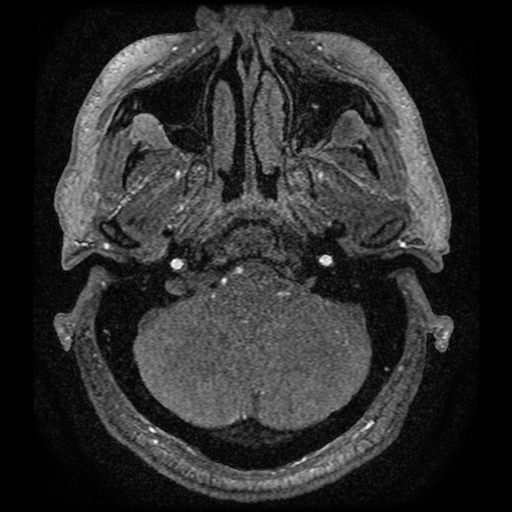 Anterior cerebral artery infarction (Radiopaedia 46794-51323 Axial MRA 5).jpg