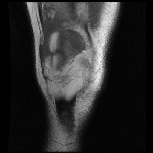 File:Anterior cruciate ligament avulsion fracture (Radiopaedia 58939-66193 Coronal T1 4).jpg