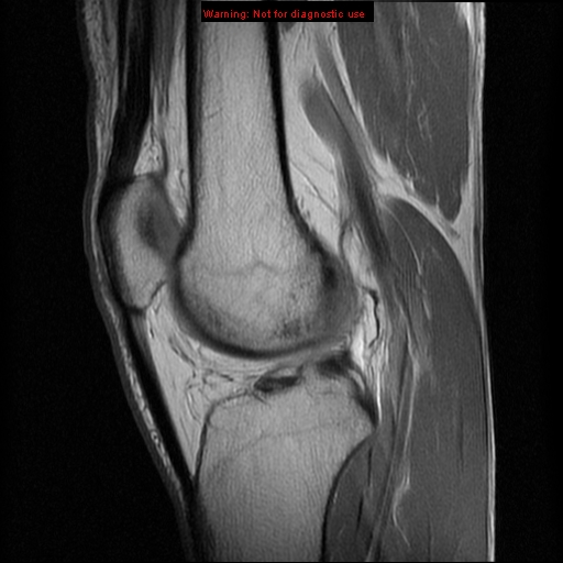 File:Anterior cruciate ligament injury - partial thickness tear (Radiopaedia 12176-12515 Sagittal PD 11).jpg