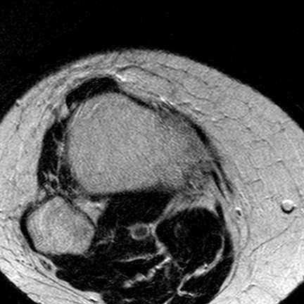 File:Anterior cruciate ligament mucoid degeneration (Radiopaedia 60853-68633 Axial T2 6).jpg