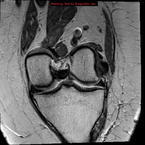 File:Anterior cruciate ligament tear (Radiopaedia 12329-12612 C 10).jpg
