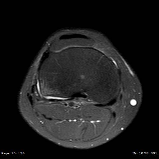 File:Anterior cruciate ligament tear (Radiopaedia 70783-80964 Axial PD fat sat 10).jpg