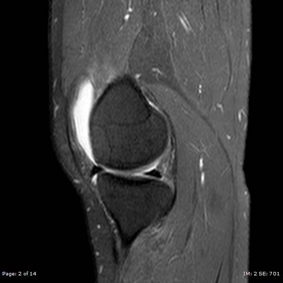 File:Anterior cruciate ligament tear (Radiopaedia 70783-80964 Sagittal PD fat sat 2).jpg