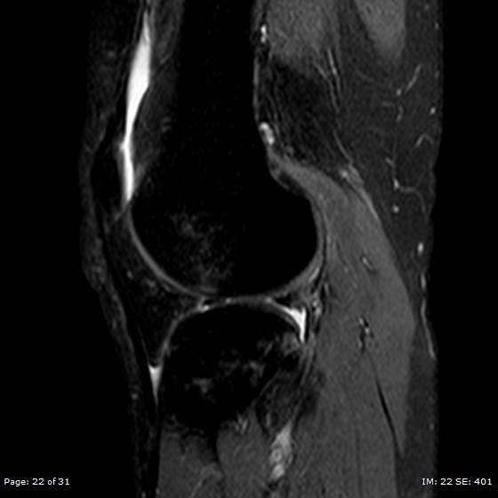 File:Anterior cruciate ligament tear (Radiopaedia 70783-80964 Sagittal STIR 22).jpg