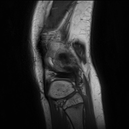 Anterior cruciate ligament tear - pediatric (Radiopaedia 62152-70260 Sagittal PD 151).jpg