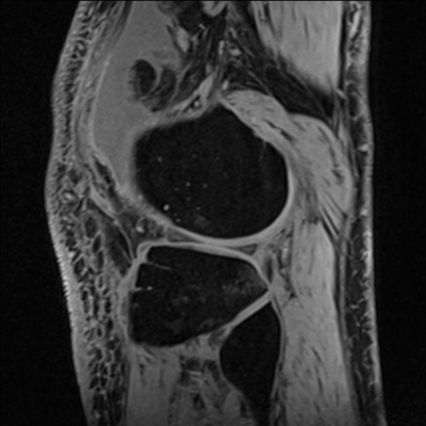 Anterior cruciate ligament tear - ramp lesion (Radiopaedia 71883-82322 Sagittal T1 vibe 34).jpg