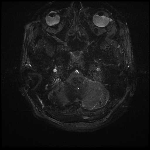 Anterior inferior cerebellar artery vascular loop - type II (Radiopaedia 70991-81209 Axial 3D FIESTA 78).jpg