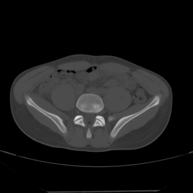 Anterior inferior iliac spine avulsion fracture (Radiopaedia 49469-54627 Axial bone window 2).jpg