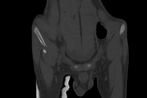 Anterior inferior iliac spine avulsion injury (Radiopaedia 88666-105376 Coronal bone window 14).jpg