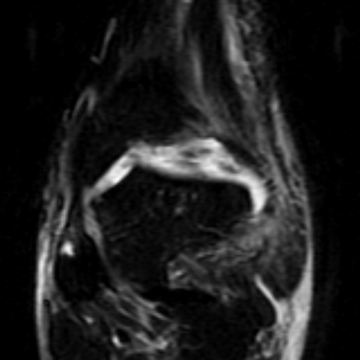 File:Anterior talofibular ligament rupture (Radiopaedia 15831-15484 Coronal STIR 7).jpg