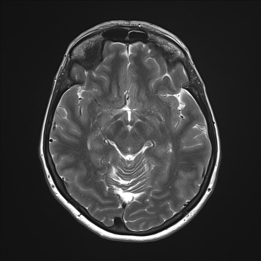 File:Anterior temporal encephalocele (Radiopaedia 82624-96808 Axial T2 16).jpg