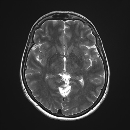 File:Anterior temporal encephalocele (Radiopaedia 82624-96808 Axial T2 18).jpg