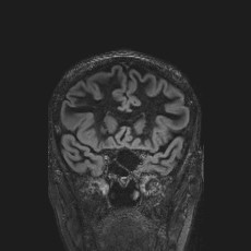 Anterior temporal encephalocele (Radiopaedia 82624-96808 Coronal FLAIR 16).jpg