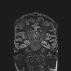 Anterior temporal encephalocele (Radiopaedia 82624-96808 Coronal FLAIR 27).jpg