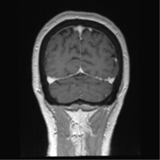 Anterior temporal pole cysts (Radiopaedia 46629-51102 Coronal T1 C+ 33).png