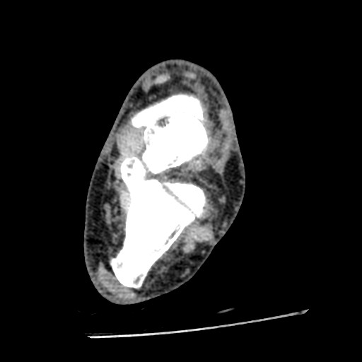 Anterior tibial artery false aneurysm (Radiopaedia 88984-105809 A 157).jpg