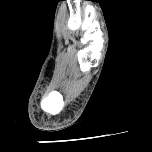 Anterior tibial artery false aneurysm (Radiopaedia 88984-105809 A 216).jpg