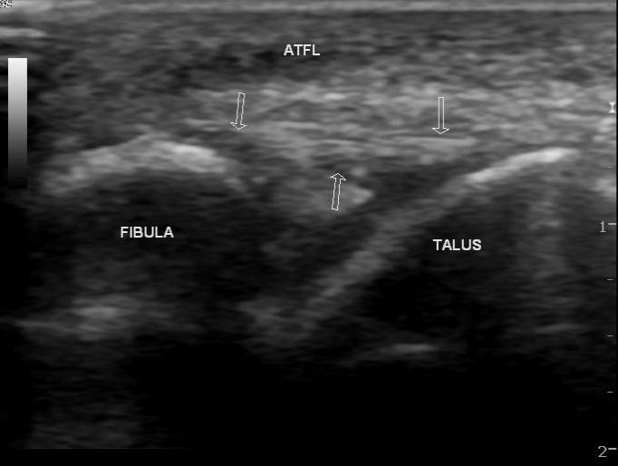 File:Anterior tibiofibular ligament sprain (Radiopaedia 43624).jpg