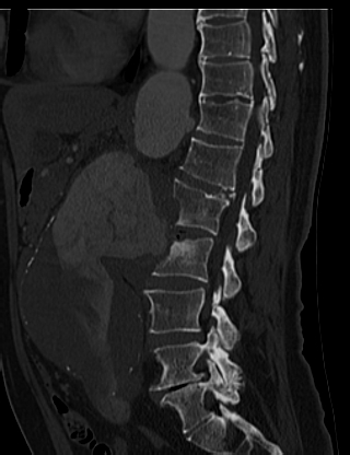 File:Anterior vertebral scalloping (abdominal aortic aneurysm) (Radiopaedia 66744-76067 Sagittal bone window 26).jpg