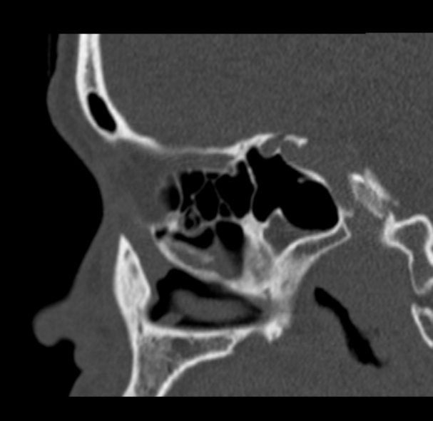 Antrochoanal polyp (Radiopaedia 33984-35202 Sagittal bone window 52).jpg