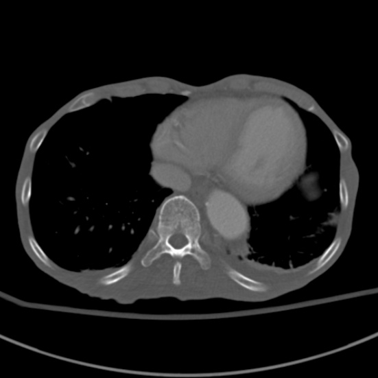 File:Aortic aneurysm with spinal destruction (Radiopaedia 42301-45410 Axial bone window 3).jpg