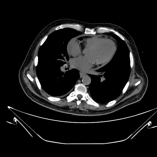 Aortic arch aneurysm (Radiopaedia 84109-99365 Axial non-contrast 165).jpg