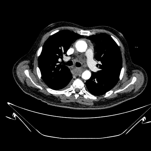 Aortic arch aneurysm (Radiopaedia 84109-99365 B 263).jpg