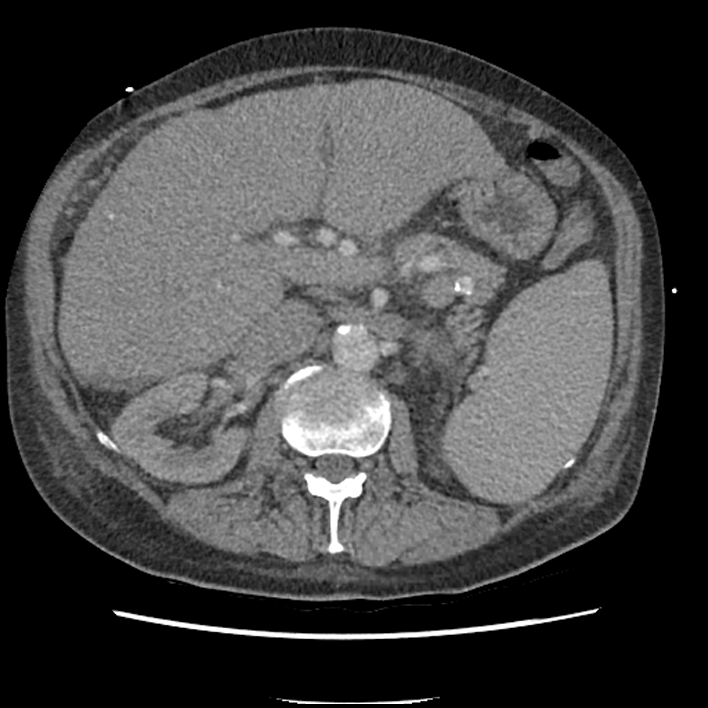 Aortic arch graft infection (FDG PET-CT) (Radiopaedia 71975-82437 A 73).jpg