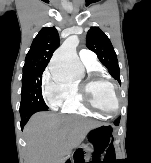 Aortic coarctation with aneurysm (Radiopaedia 74818-85828 C 35).jpg