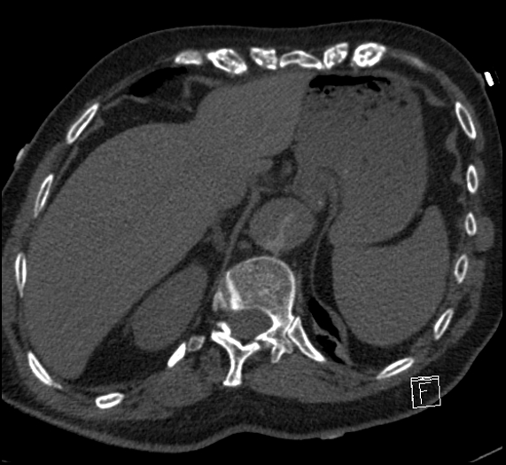 Aortic dissection (CTPA) (Radiopaedia 75506-86751 Axial C+ CTPA 122).jpg