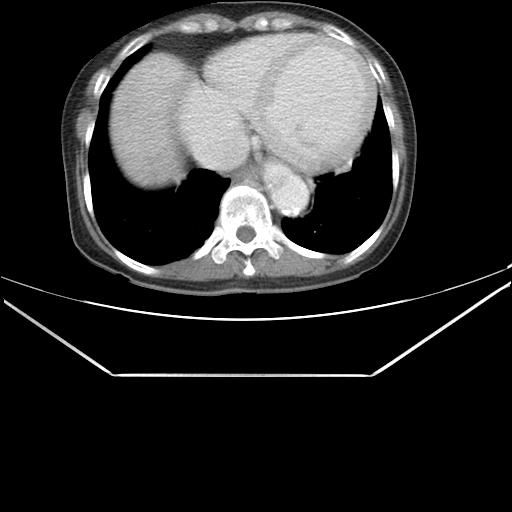Aortic dissection (Radiopaedia 25350-25604 C 40).jpg