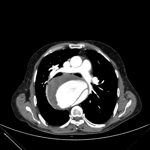 Aortic dissection (Radiopaedia 27466-27665 C+ arterial phase 107).jpg