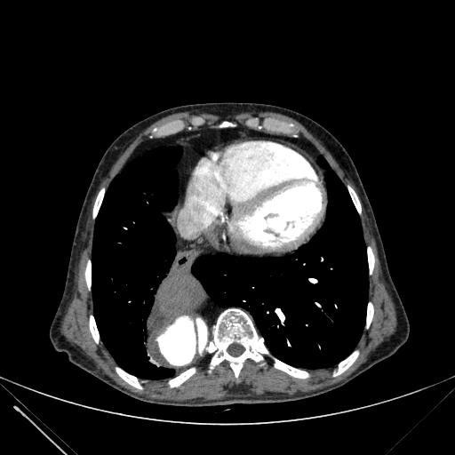 Aortic dissection (Radiopaedia 27466-27665 C+ arterial phase 216).jpg