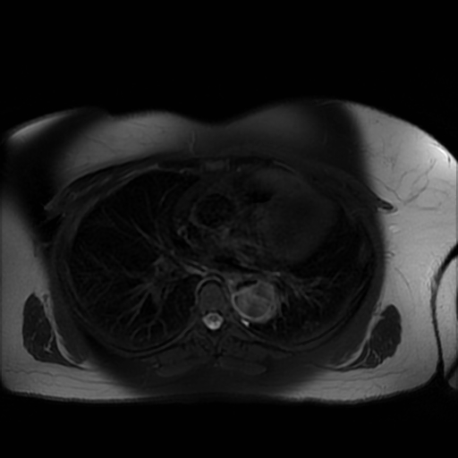 File:Aortic dissection (Radiopaedia 57969-64956 Axial T2 fat sat 3).jpg