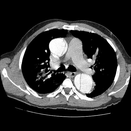 File:Aortic dissection - Stanford A -DeBakey I (Radiopaedia 28339-28587 B 32).jpg