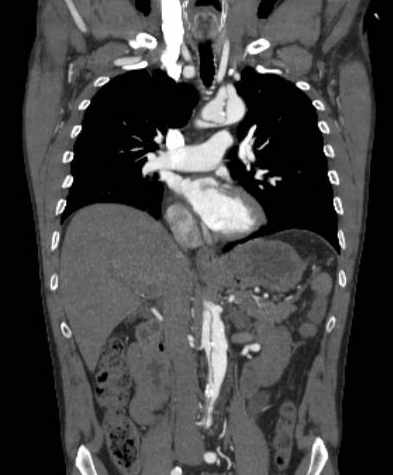 File:Aortic dissection - Stanford type B (Radiopaedia 73648-84437 B 58).jpg