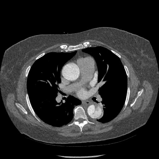 File:Aortic dissection - Stanford type B (Radiopaedia 88281-104910 A 41).jpg