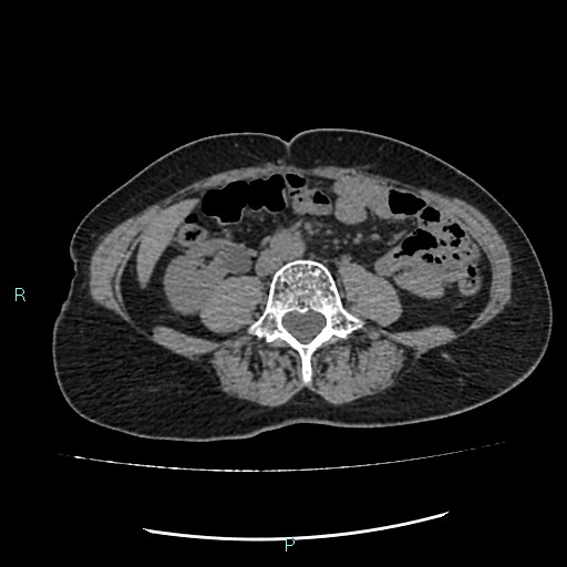 File:Aortic dissection extended to lusory artery (Radiopaedia 43686-47136 Axial non-contrast 40).jpg