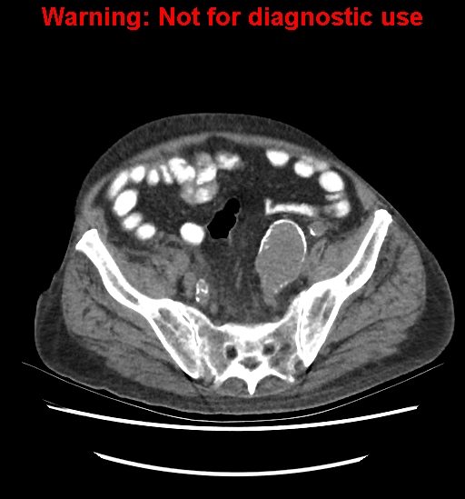 Aortic graft infection (Radiopaedia 44979-48907 Axial non-contrast 75).jpg